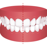 cross bite cross bite